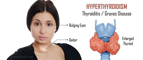 dating someone with hyperthyroidism